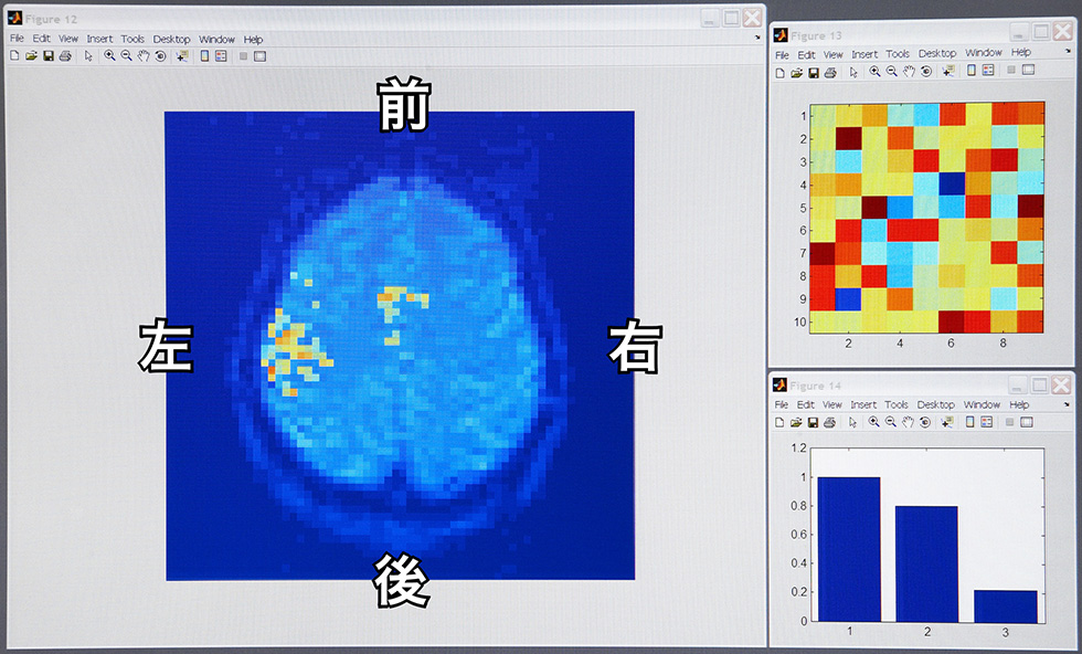 Analysis of a brain image by a computer program (Left) Active brain areas (Upper right) Extracted brain activity patterns (Lower right) Pattern classification processing